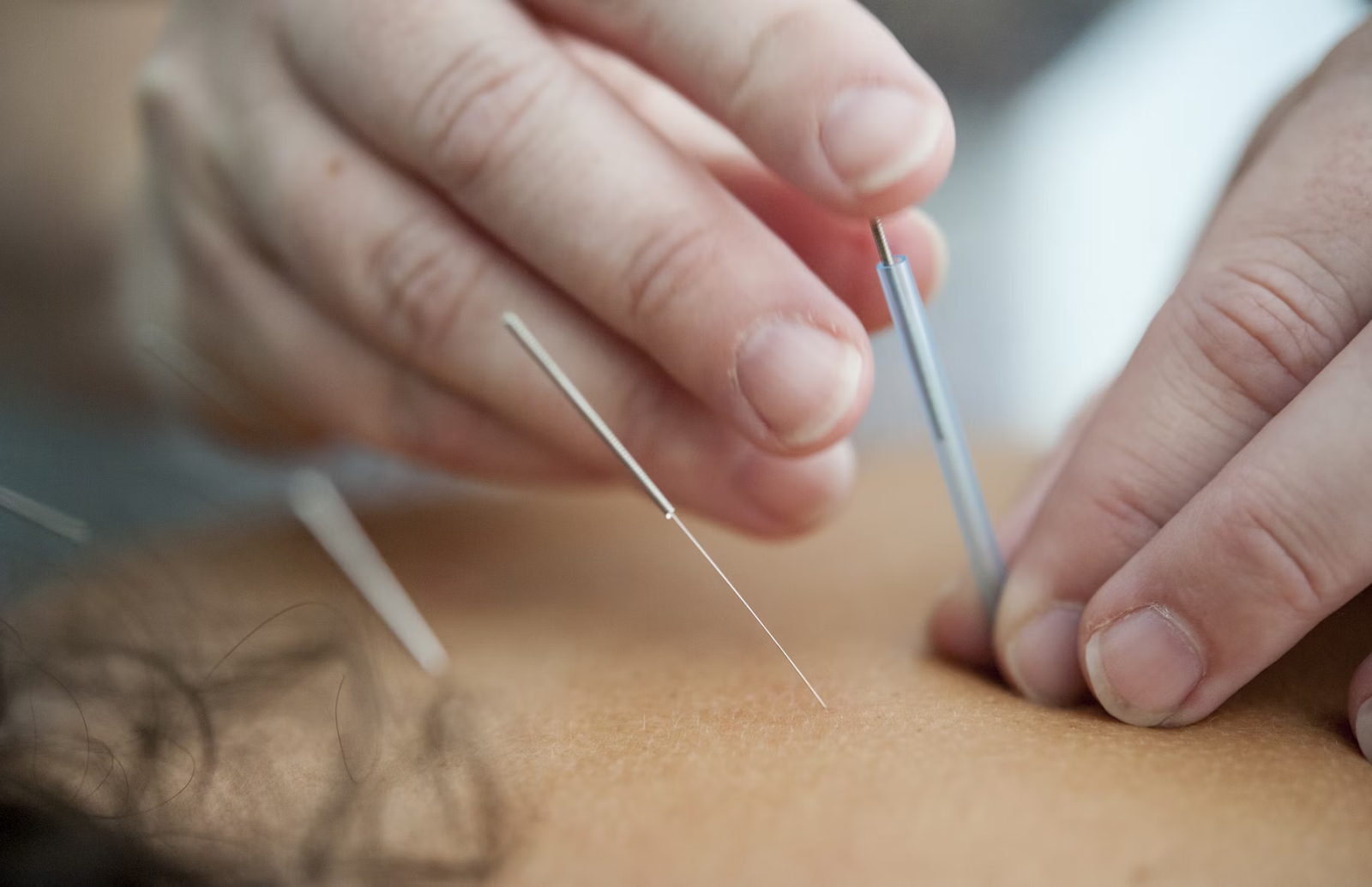 acupuncture vs chiropractic